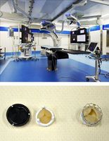 ［上］ＴＡＶＩの手術を行うハイブリット手術室＝徳島大病院（同病院提供）［下］開胸手術で使う人工弁（左、中）と、ＴＡＶＩでカテーテルを使って取り付けられる人工弁（右）
