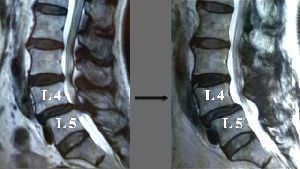 ［写真左］第４、５腰椎の骨のずれによって脊柱管が狭くなった状態［写真右］手術後