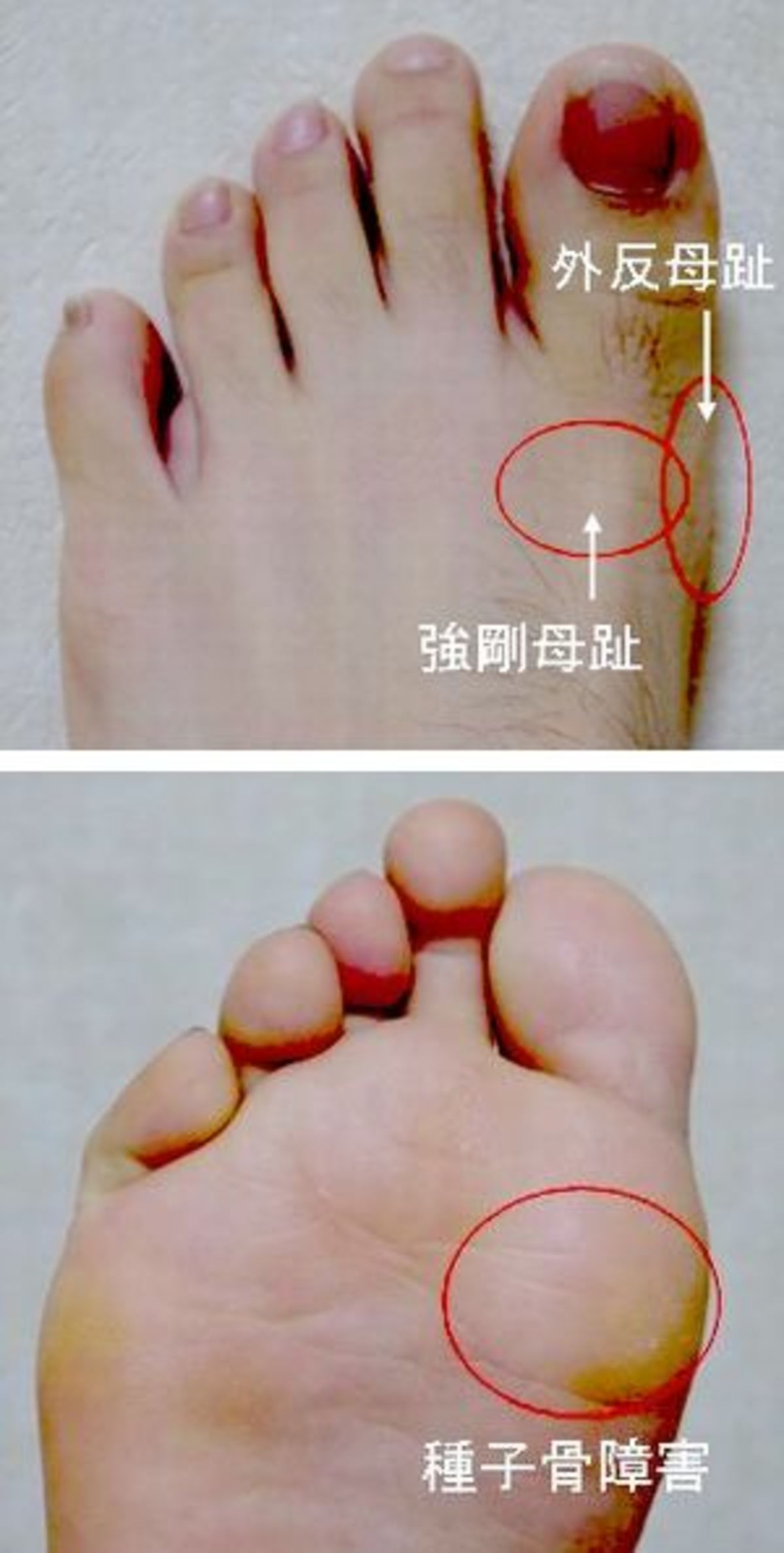 足のトラブル 健康相談 徳島新聞