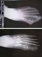 ［上］親指が変形して曲がった足［下］スクリューやワイヤで固定する手術後。親指の変形がまっすぐになった（齋藤副院長提供）